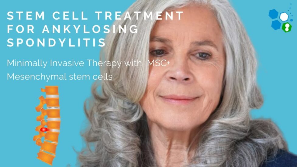 ankylosing spondylitis stem cell treatment