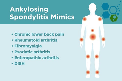 Disease Control Data, Ankylosing Spondylitis