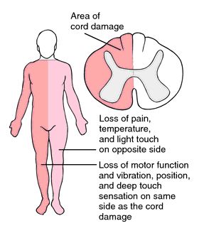 Transverse-myelitis-cure