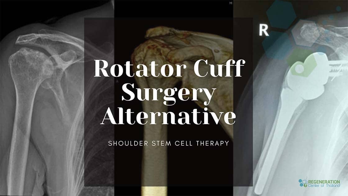 Rotator Cuff Treatments