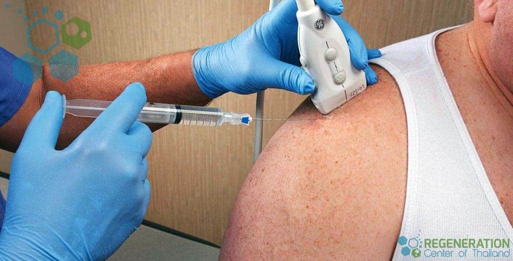 stemcell-shoulder-injection-regeneration-center