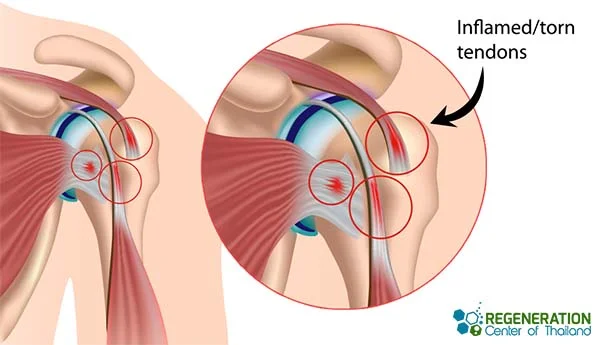 Stem Cell Treatment for Torn Rotator Cuff : Our New Research