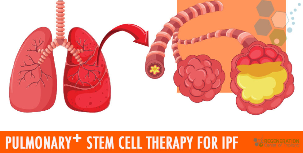 Stem-Cell-Treatment-IPF-Pulmonary-Fibrosis-2022