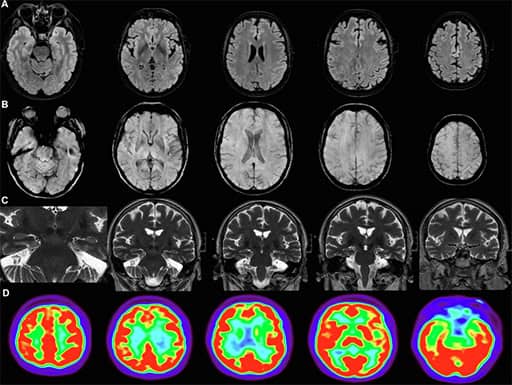 Brain Fog Test: Symptoms, Diagnosis, and Treatment [2024]