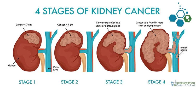 4-stages-kidney-cancer