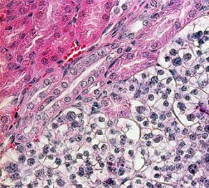 Kidney-cancer-stemcells