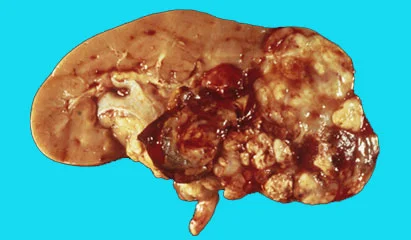 kidneycancertumor