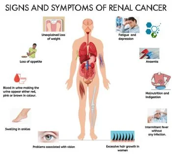 signs-of-kidney-cancer