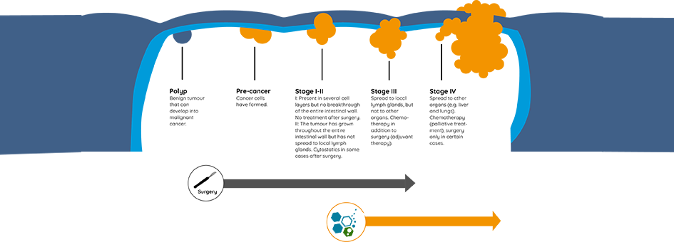 phases-stages-treatment-colon-cancer-immunotherapy