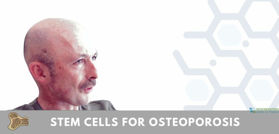 Stem Cell Treatment for Osteoporosis