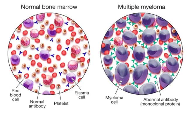 cancer-multiple-myeloma-treatment-stemcells