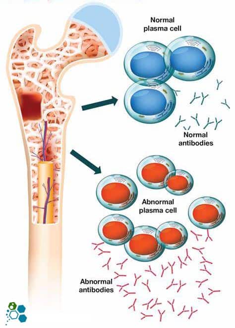 normal-vs-abnormal-cells-Multiple-Myeloma