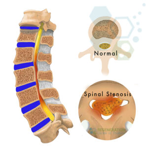 Evidence Based Stem Cell Treatment for Spinal Stenosis