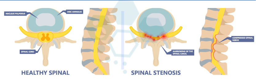 spinal-stenosis-new-treatment