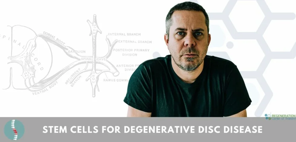 Can Stem Cells Help Reverse Degenerative Disc Disease?