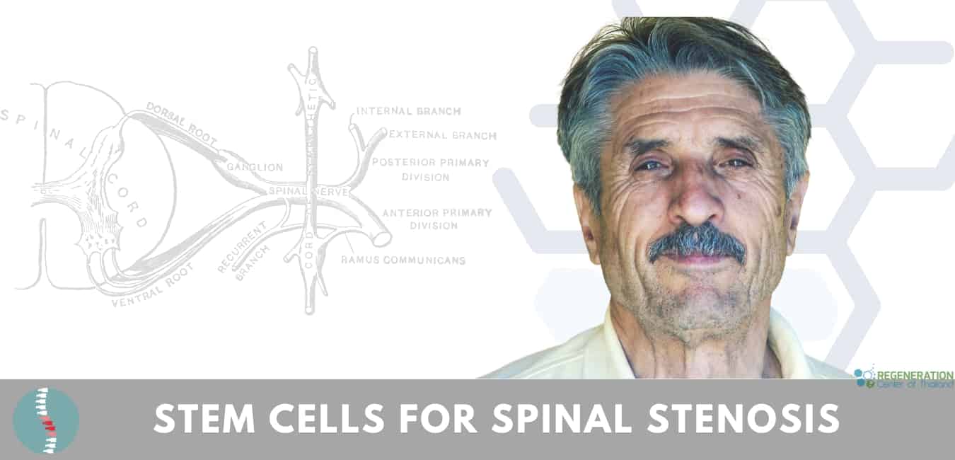 Stem Cell Therapy for Spinal Stenosis - Regenerative Orthopedic Institute