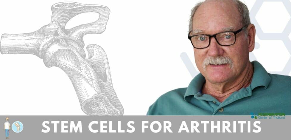 Stem Cell Treatment for Arthritis Rheumatoid Osteoarthritis
