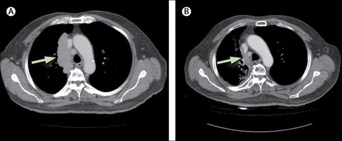 before-after-stem-cell-therapy-mesotheioma