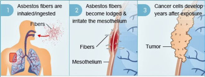 development-of-mesothelioma-treatments