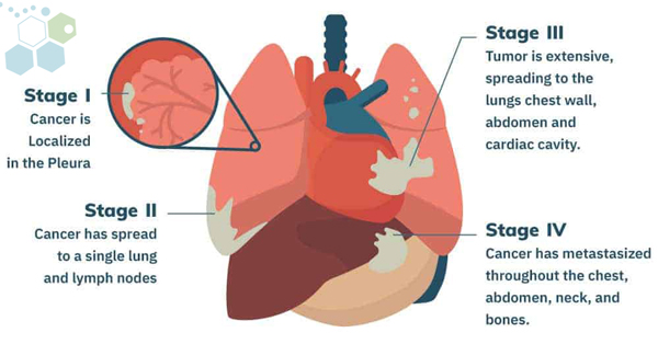 immunotherapy-treatment-mesothelioma