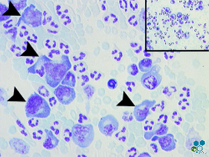 malignant-cells-mesothelioma-treatmen