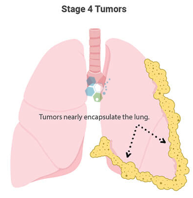 new-treatments-for-mesothelioma