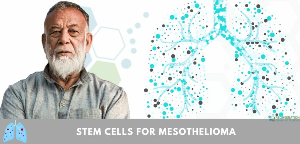 stem cell treatment for Mesothelioma
