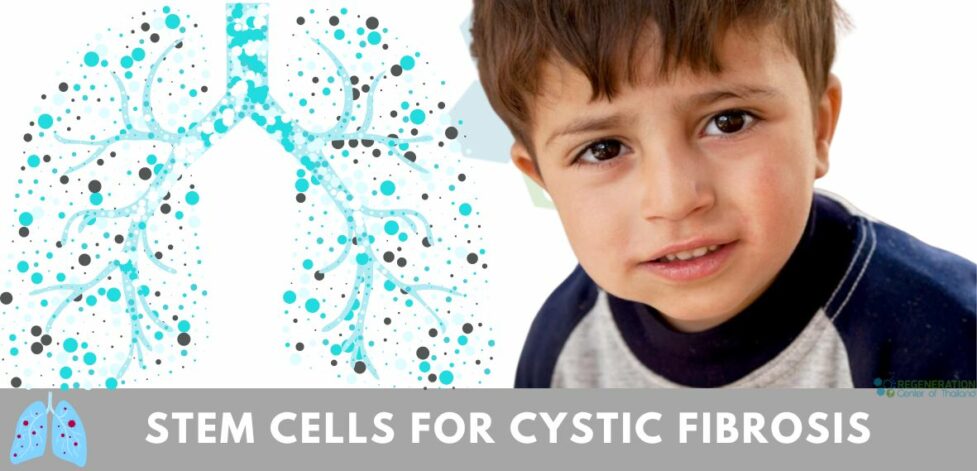 MSC+ Stem Cell therapy for Cystic fibrosis