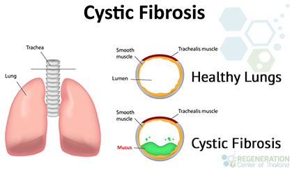 cystic fibrosis lungs diagram