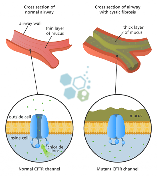 cystic-fibrosis-treatment-stem-cells