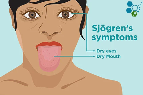 stem-cells-Treatment-sjogren's-syndrome