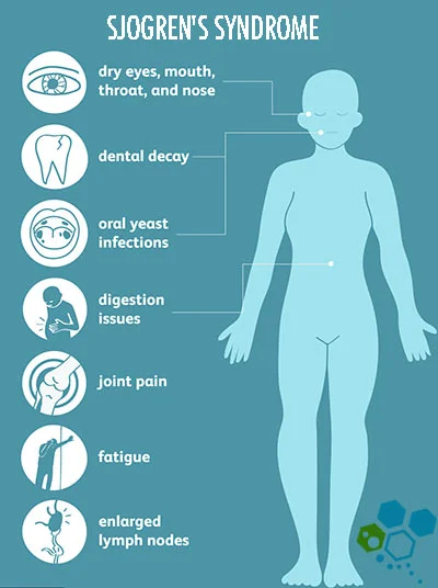 Sjögren's Syndrome: 'Exercise Used to Be Agony