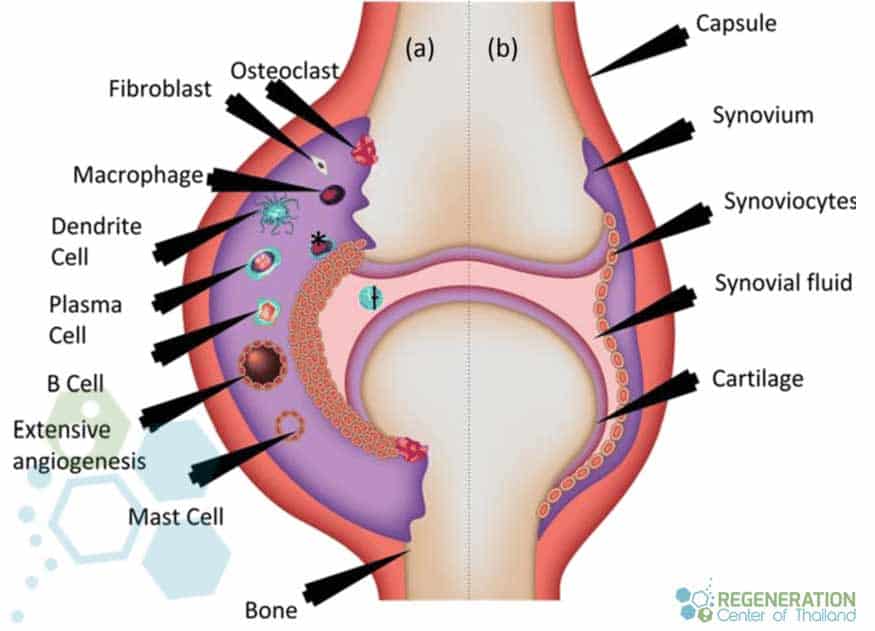 Before-after-Stem-Cells-therapy-Rheumatoid-Arthritis