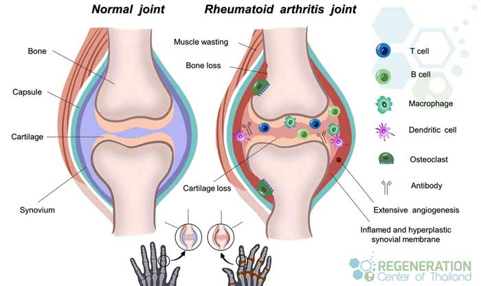 Cost-Stem-Cells-therapy-Rheumatoid-Arthritis