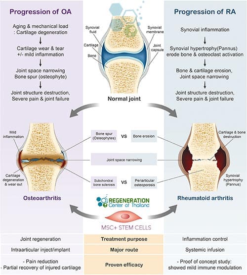 rheumatoid arthritis treatment natural