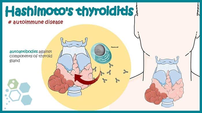 stem-cell-treatment-Hashimotos-thyroiditis