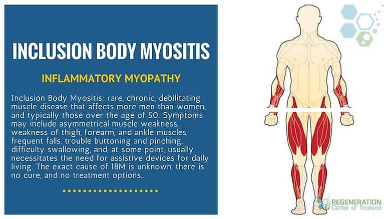 Stem Cell Therapy for Inclusion Body Myositis - Autoimmune IBM