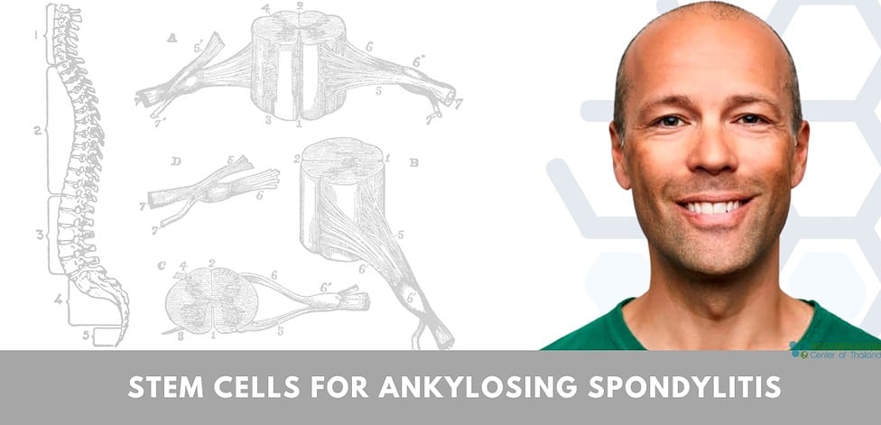 Stem Cell Treatment for ankylosing spondylitis stage 4 Advanced