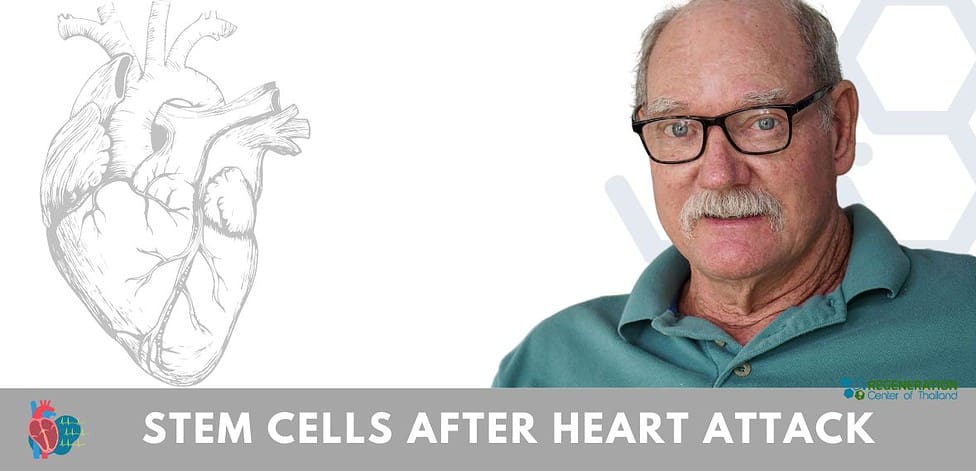 Cost of Stem Cell Treatment After Heart Attack