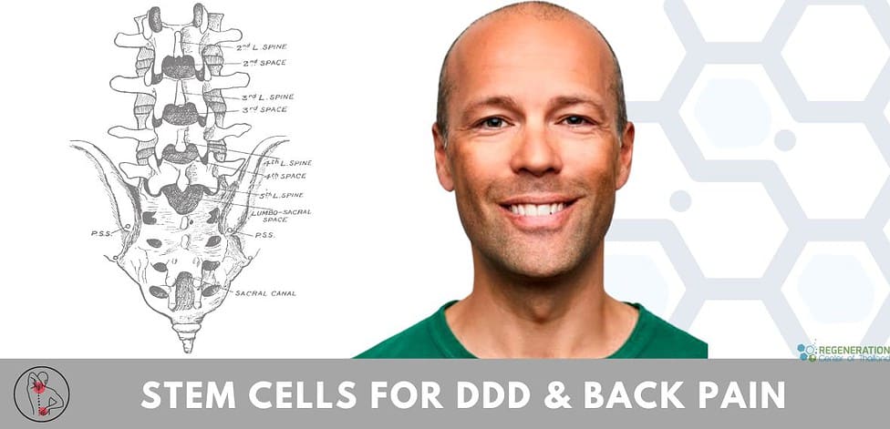 Stem Cell Treatment for degenerative disc disease DDD back pain