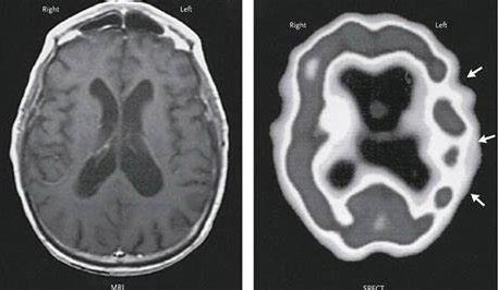 before-after-stem-cells-aphasia