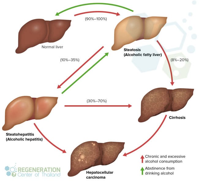 3-stages-of-alcoholic-liver-disease-stem-cell-therapy