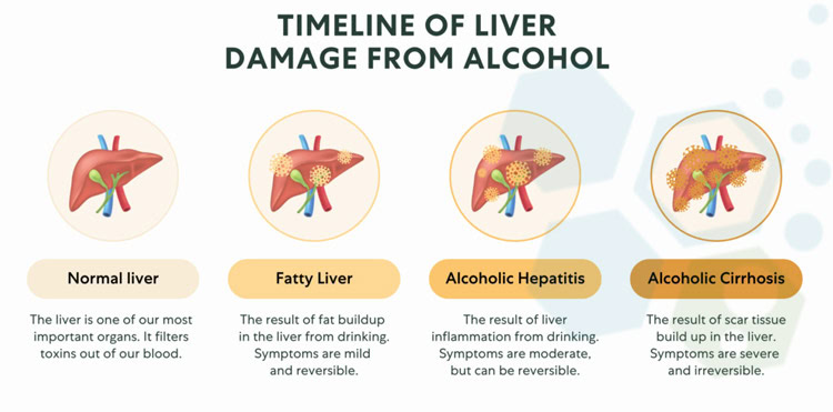 Alcoholic-liver-disease-stem-cells