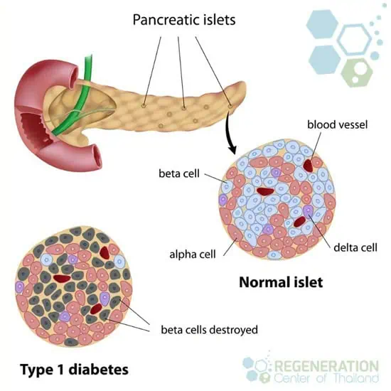 islet-cells-replacement-type1-diabetes-regen-center