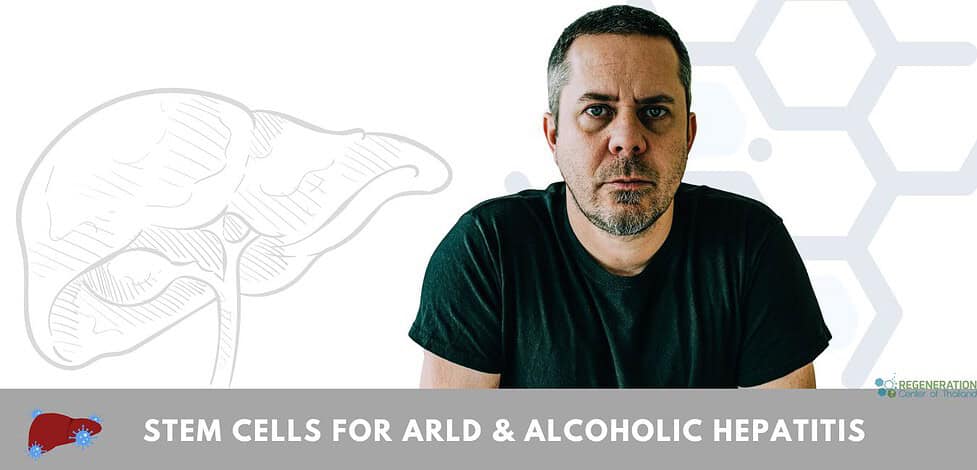 stem cell therapy for Alcohol-related liver disease (ARLD) and Alcoholic Hepatitis