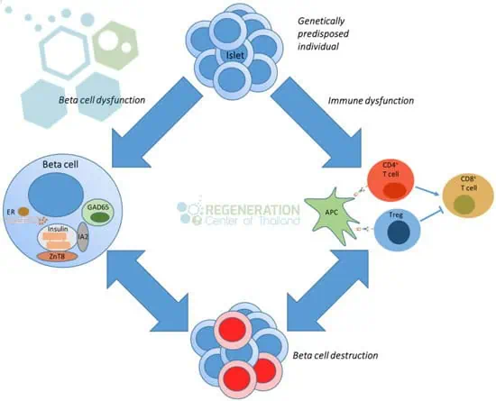 stemcells-type-1-diabetes-reversal