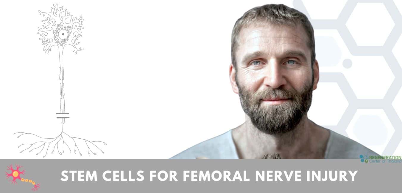 Stem Cells for Femoral Nerve Injury: Alleviate Pain