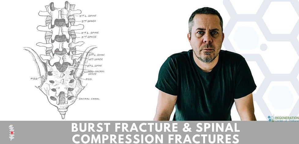 Stem Cell Therapy after Burst Fracture & Spinal Compression Fracture