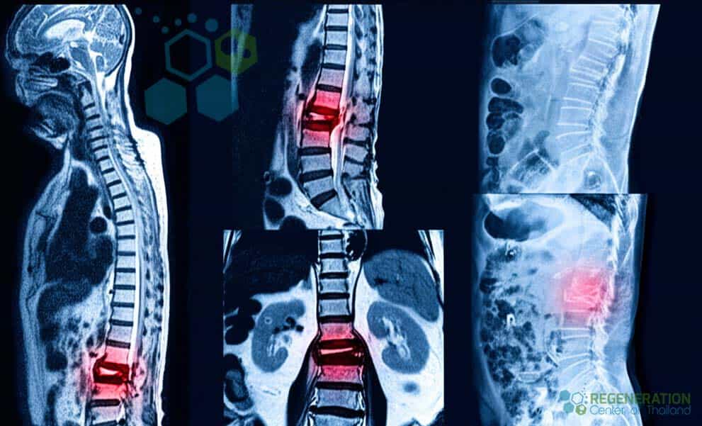 Stem-Cell-Therapy-for-High-impact-spinal-trauma