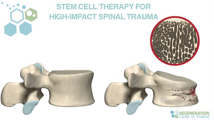 Stem-Cell-Therapy-for-burst-fracture-spinal-compression